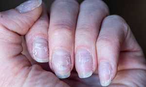 Диагностика и лечение дерматологического заболевания Кандидоз ногтей: советы и рекомендации