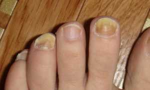Причины, симптомы и эффективное лечение грибка ногтей: полезные советы