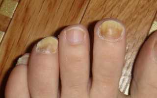 Причины, симптомы и эффективное лечение грибка ногтей: полезные советы