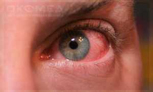 Распознаём грибок глаз по основным симптомам и рекомендациям