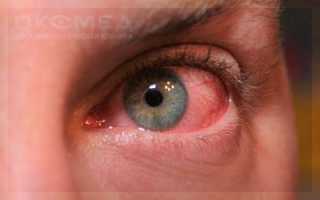 Распознаём грибок глаз по основным симптомам и рекомендациям