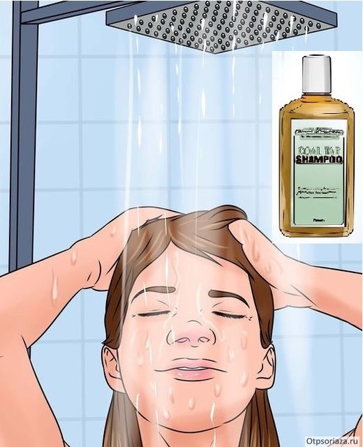 Шампуни от псориаза Шампуни для лечения псориаза волосистой части головы