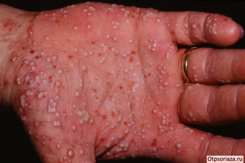 Акродерматит Аллопо Акродерматит Аллопо