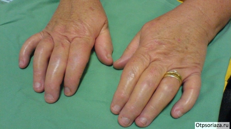 Артропатический псориаз Артропатический псориаз