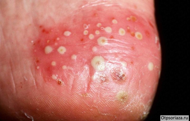 Экссудативный псориаз Экссудативный псориаз