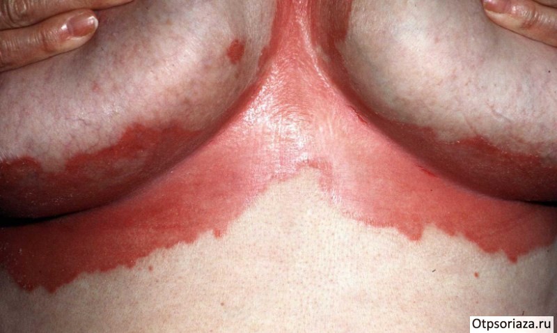 Импетиго Гебры Импетиго Гебры