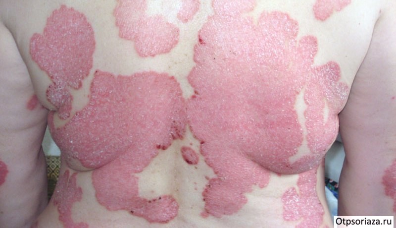 Интертригинозная форма псориаза Интертригинозная форма псориаза