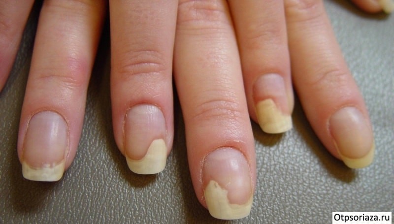 Онихомадез Онихомадез