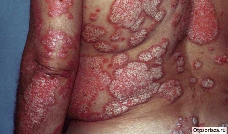 Острый пустулёзный псориаз Острый пустулёзный псориаз