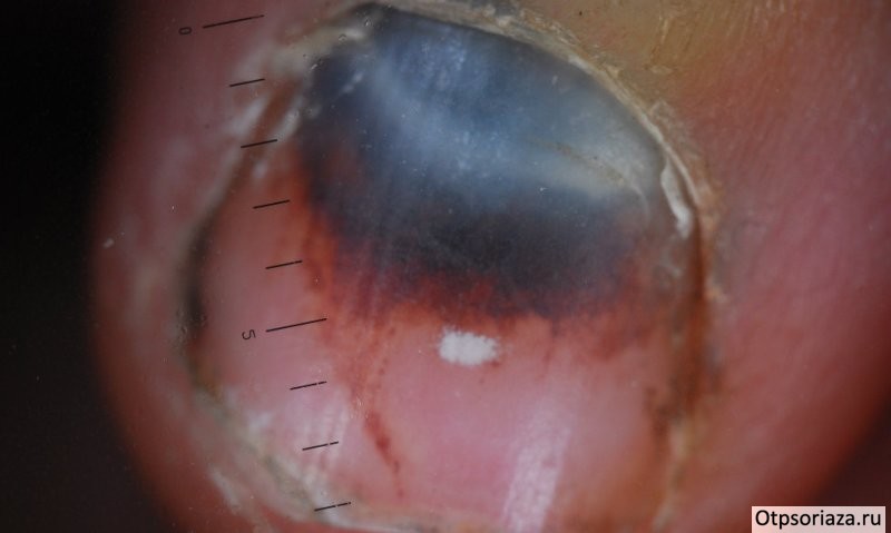 Подногтевые геморрагии Подногтевые геморрагии