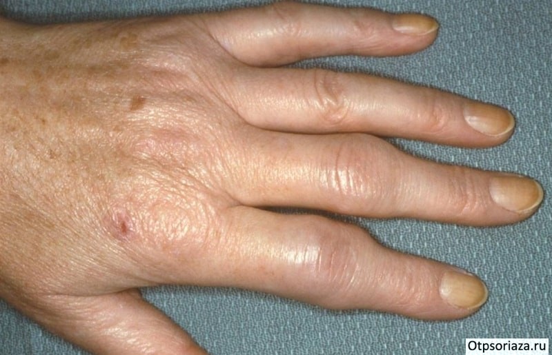 Псориатический артрит Псориатический артрит