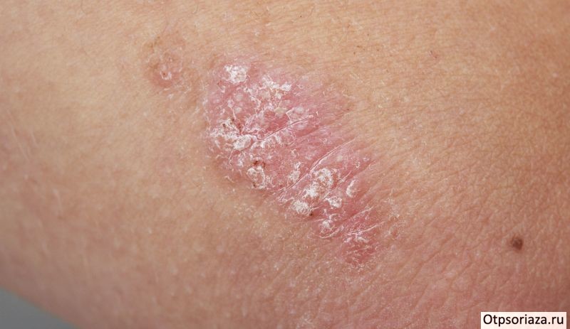 Псориатическое пятно Псориатическое пятно