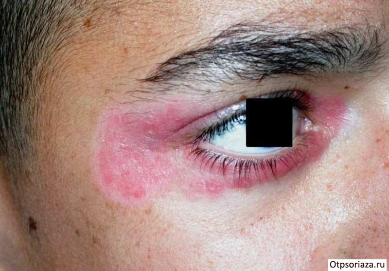 Псориаз на веке Псориаз на веке