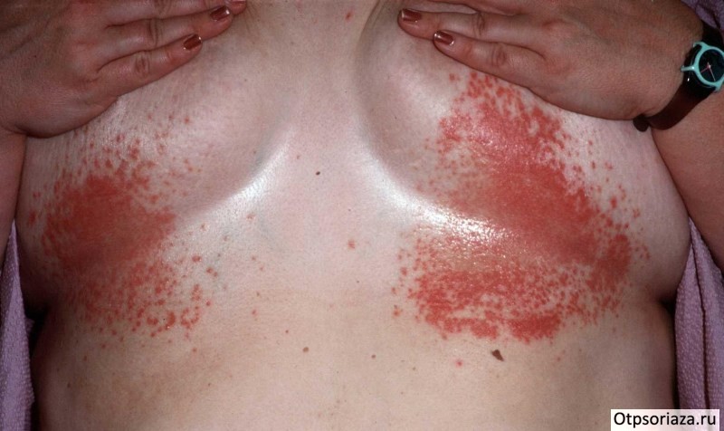 Псориаз у женщины Псориаз у женщины