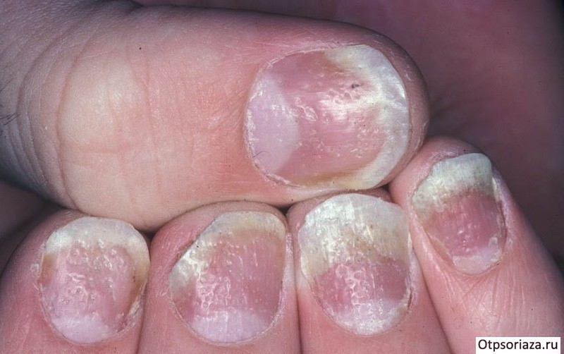 Синдром напёрстка Синдром напёрстка