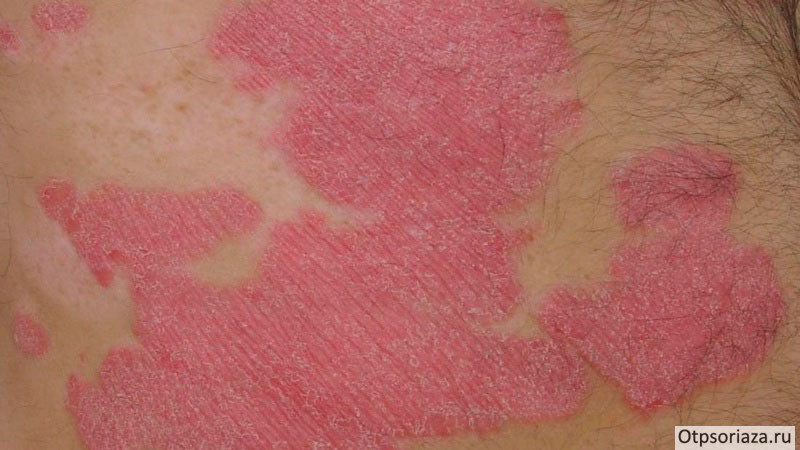 бляшки-на-теле Бляшки на теле