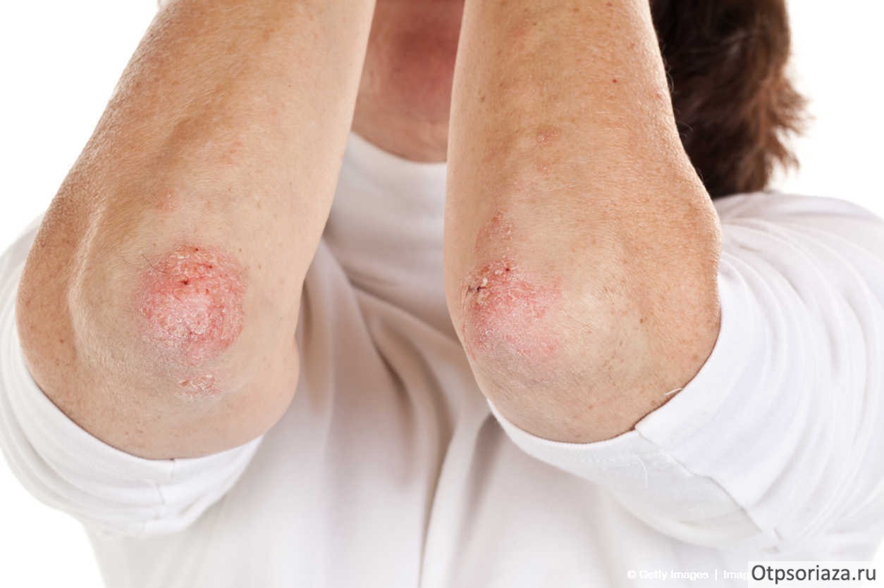 Чем опасен псориаз? последствия псориаза