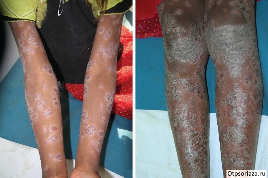Бляшковидный псориаз Обычный детский псор