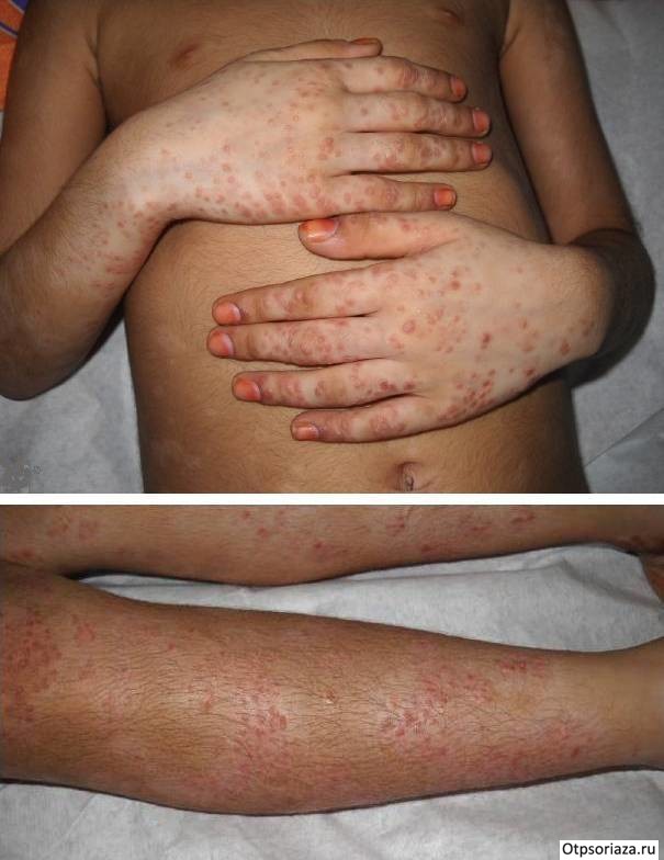 Псориаз каплевидный Каплевидный детский псориаз