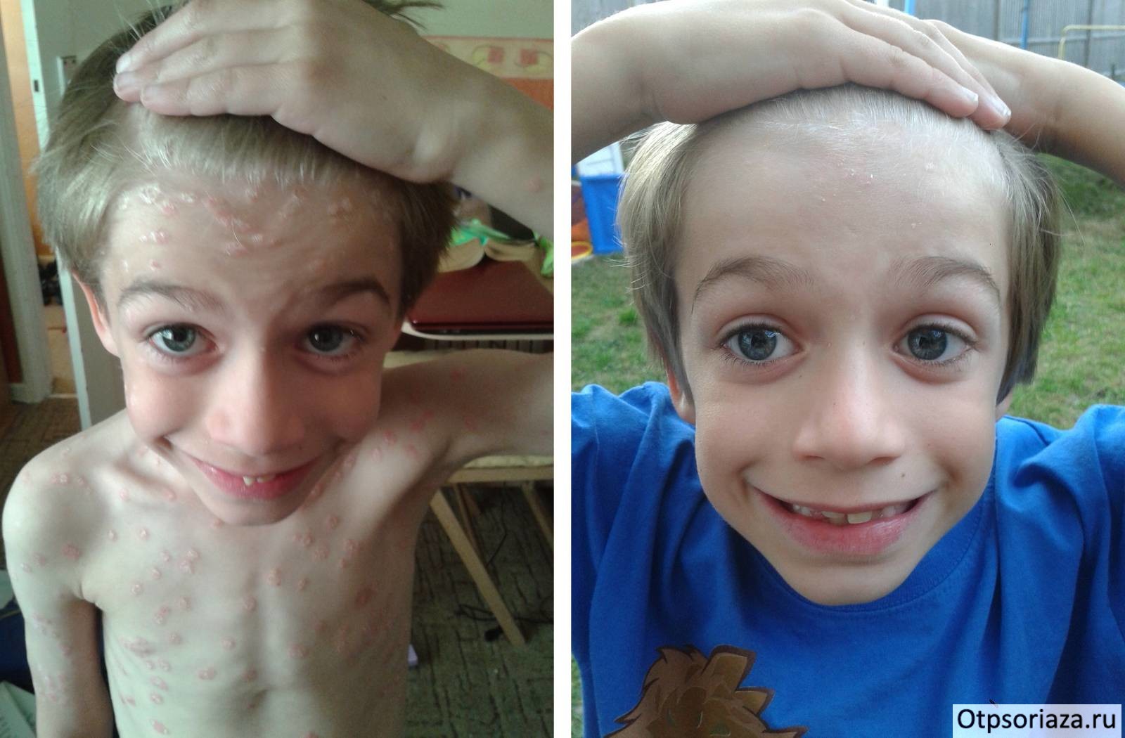 Лечение псориаза у детей Мальчик после лечения псориаза