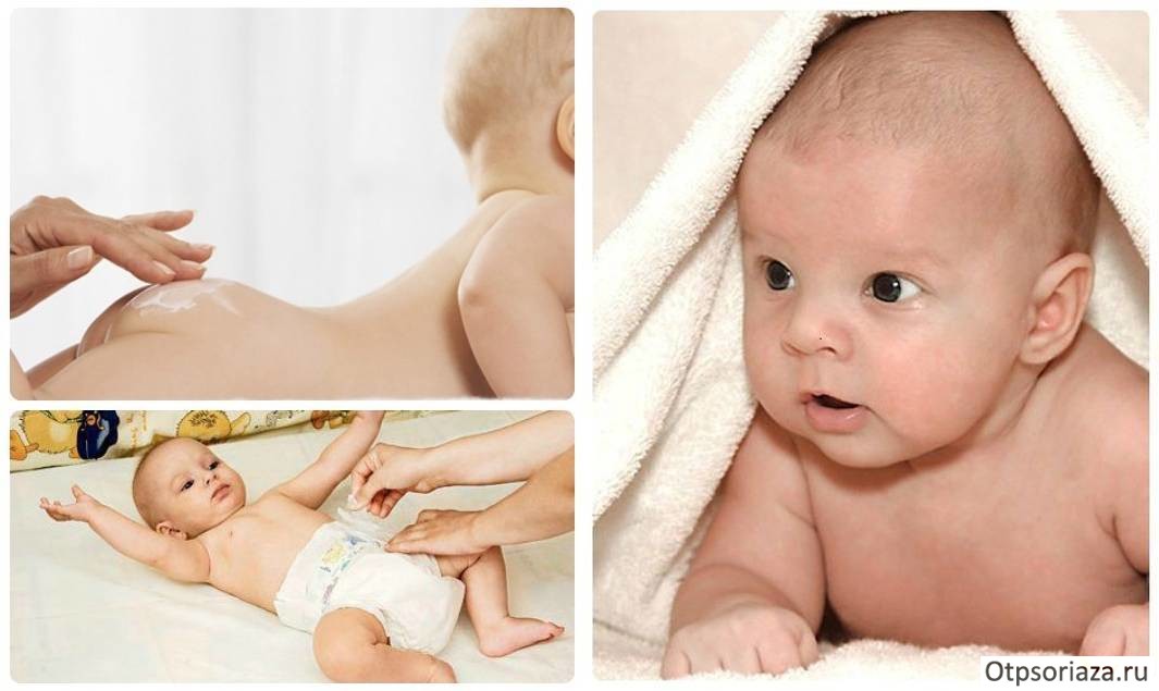 Пелёночный псориаз Псориаз у детей до года