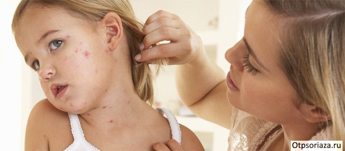 Диагностика детского псориаза Диагностика детского псориаза