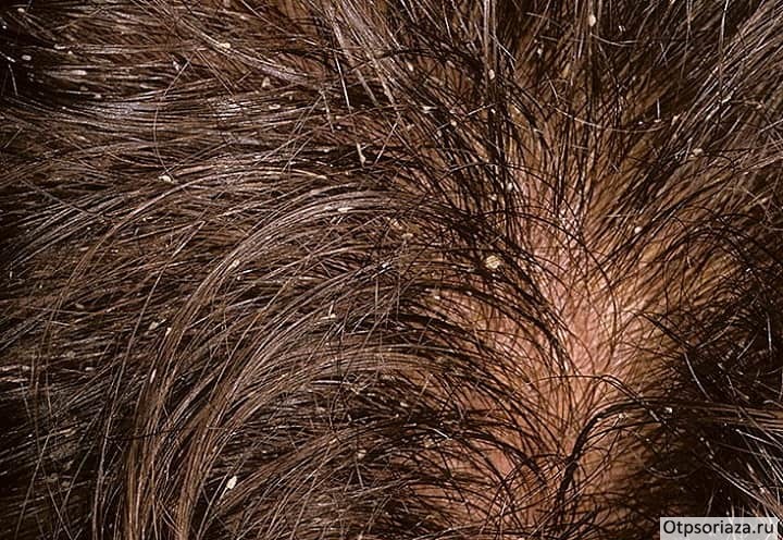 голова-min Себорейный псориаз на волосах