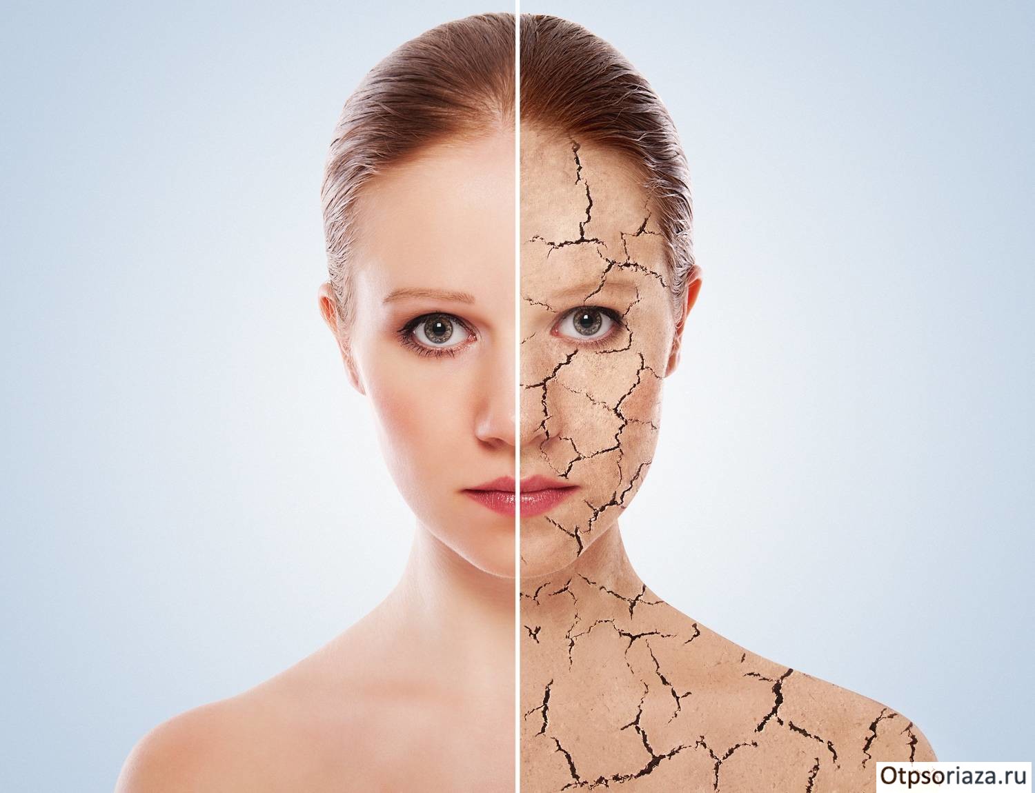 Как передается псориаз? Каким образом передается псор