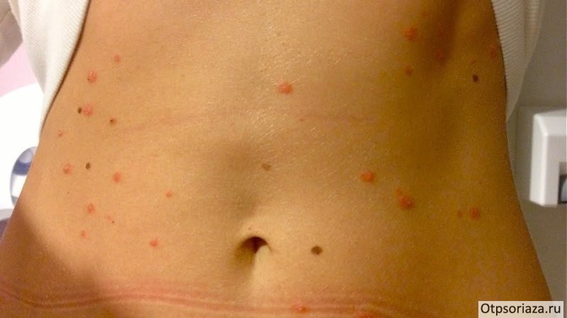 каплевидный псориаз на теле Каплевидный псориаз на теле