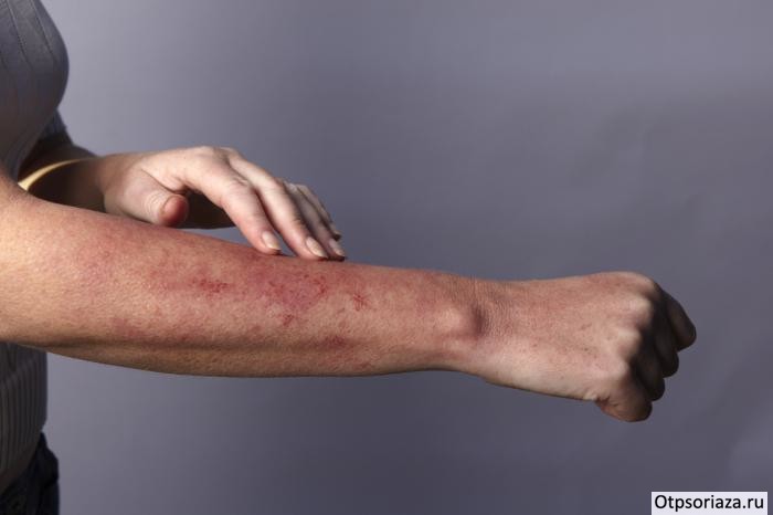 Применение мазей при псориазе Применение мазей при псориазе