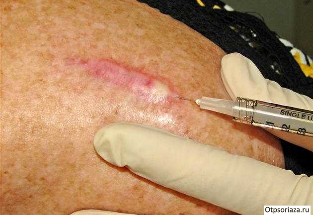 Отзывы об уколах Отзывы об уколах от псориаза