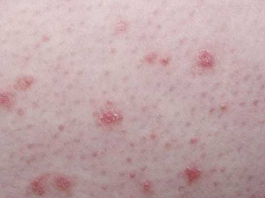 начальная стадия псориаза Начальная стадия псориаза