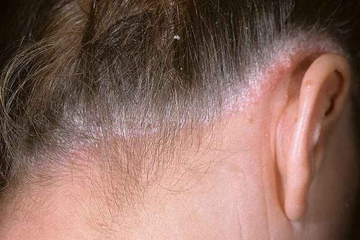 псориаз головы псориаз на голове