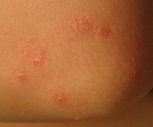 псориаз на локтях псориаз на локтях