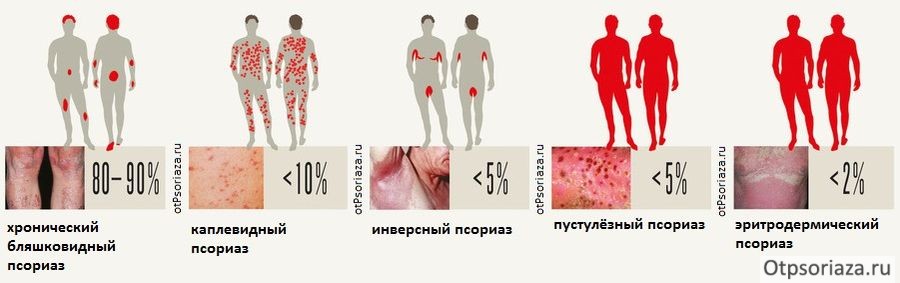 Статистика проявления псориаза статистика по видам псориаза в процентах