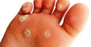 Симптомы дисгидротического грибка стопы