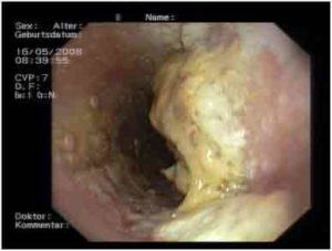 Кандидоз пищевода
