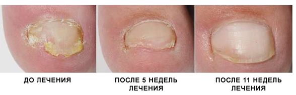 лечение грибка ногтей